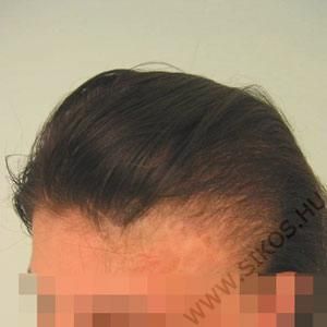 Égés utáni heges hajhiány pótlása hajátültetés hajbeültetés műtéttel Égés utáni heges hajhiány pótlása hajátültetés hajbeültetés műtéttel