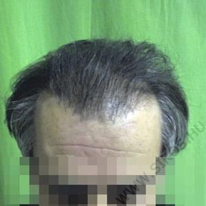 Hajátültetés (hajbeültetés) után