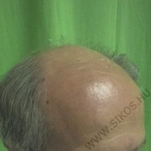 Hajátültetés ( Hajbeültetés ) előtt