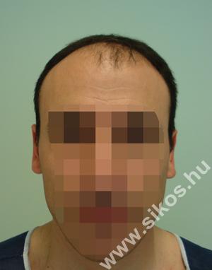 Hajátültetés, hajbeültetés előtt Hajátültetés, hajbeültetés előtt