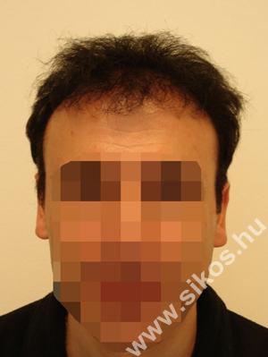 Hajbeültetés-hajátültetés után Hajbeültetés-hajátültetés után