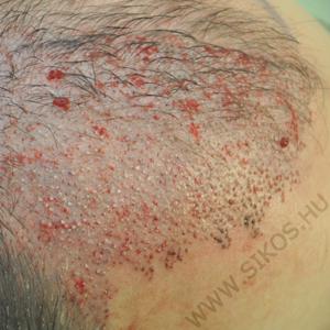 A befogadóhely FUE graftok beültetése után közvetlenül A befogadóhely FUE graftok beültetése után közvetlenül